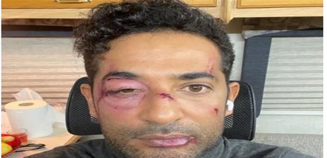 الفنان الشهير يرعب جمهوره.. ظهر بوجه مليء بالكدمات والجروح! 