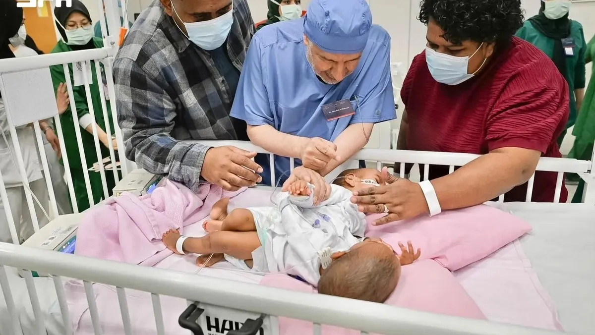 15 ساعة و34 مختصاً...السعودية تبدأ عملية معقدة لفصل توأمتين ملتصقتين