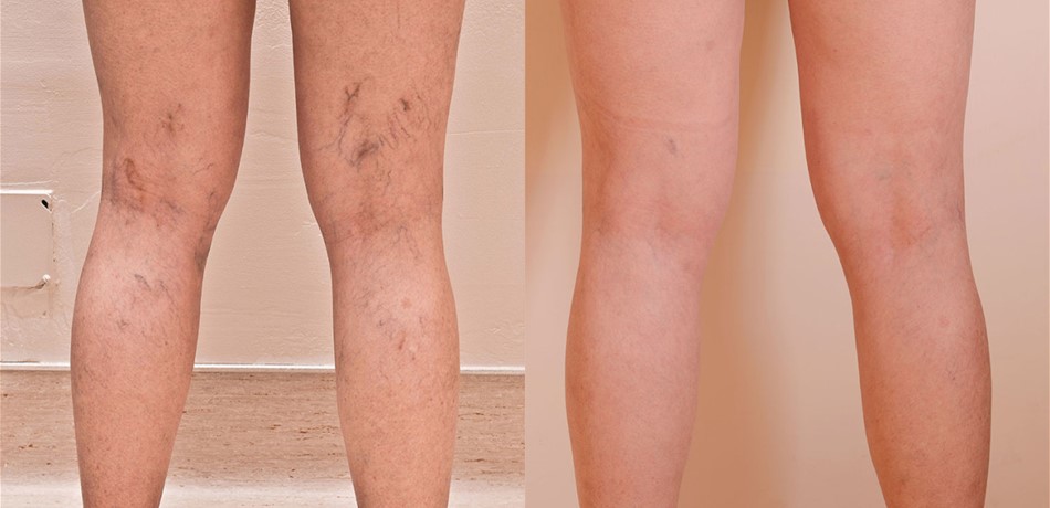 تحذير للنساء.. لا تتجاهلن الـSpider Veins!