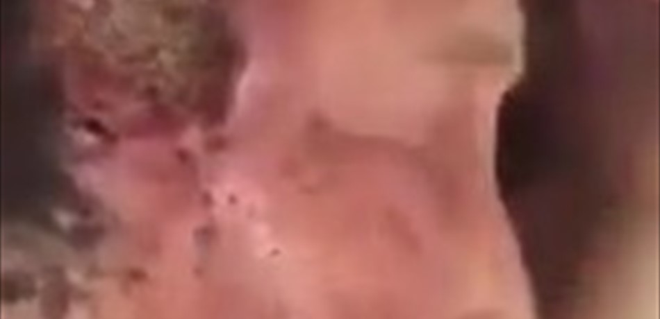 فيديو مقزّز.. حشرات صغيرة تتغذّى على رأس رجل!