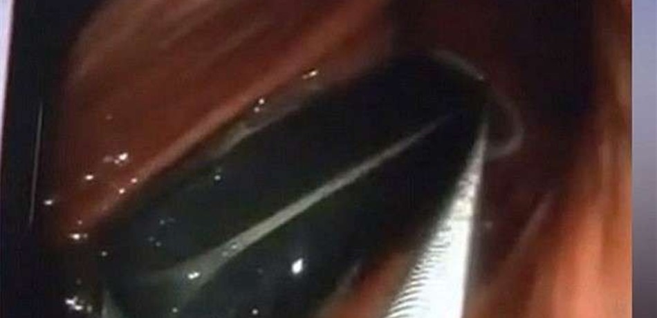 استخراج ولاعة ابتلعها رجل قبل 20 عاماً