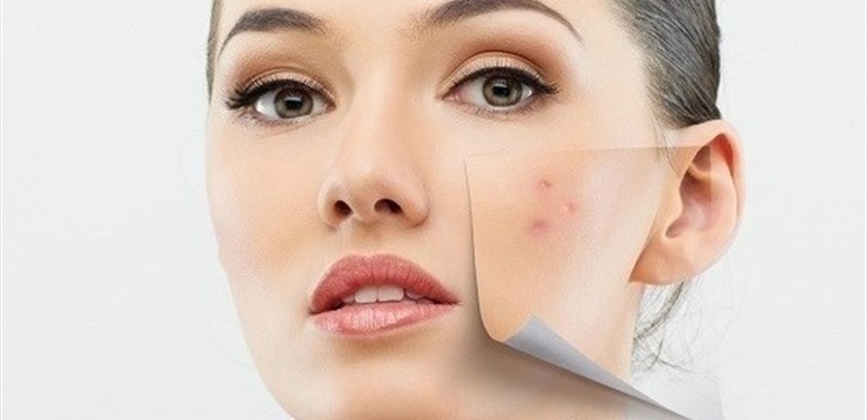 بهذه الطرق تحاربين البثور الهرمونية