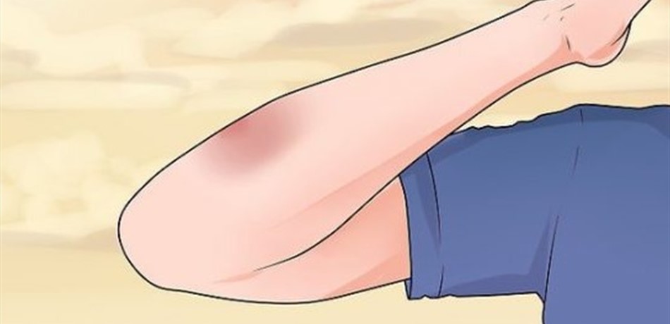 تعرفوا إلى أسباب ظهور الكدمات على أجسامكم