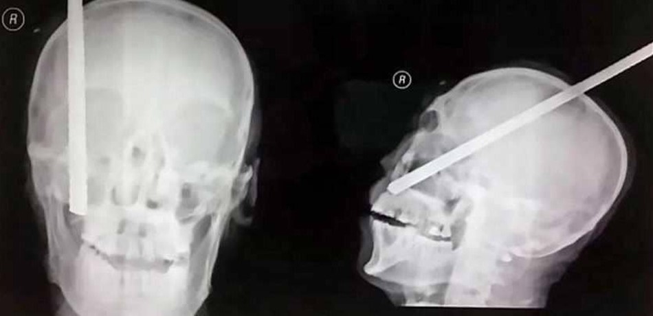 بالصورة.. من له عمر لا يقتله دخول قضيب حديدي في رأسه! 