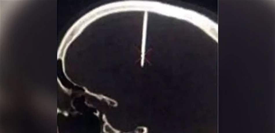 عانى من آلام حادة.. فعثر الأطباء على مسمار في جمجمته