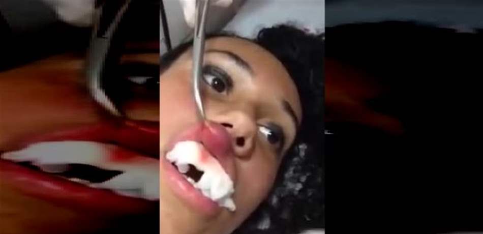 لقطات مروّعة.. لحظة استخراج دودة عملاقة من شفاه فتاة! (فيديو) 