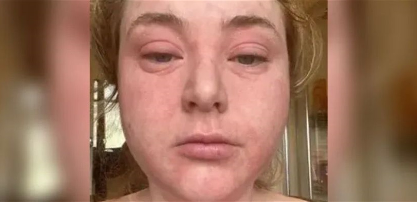 اسكتلندية أرادت تجميل أسنانها بـالفينير... والنتيجة كانت صادمة!