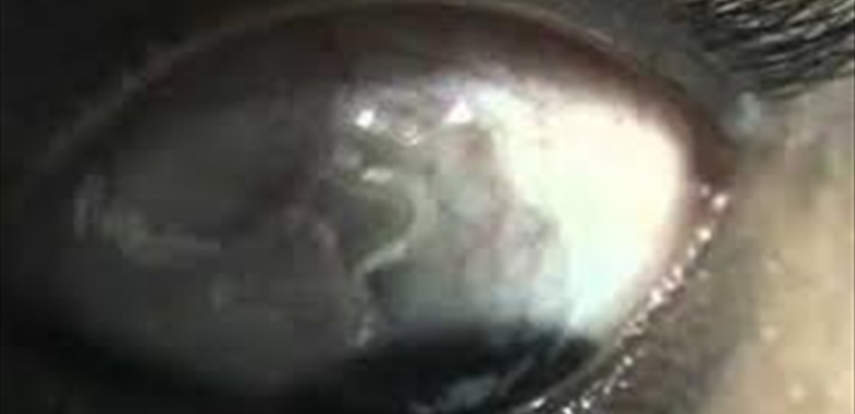 مخلوق يستوطن عين فتى ويحير الأطباء.. ما هو؟