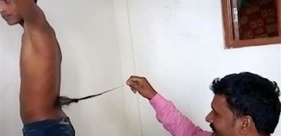 ذيلٌ بطول نصف متر ينمو في ظهر فتى!