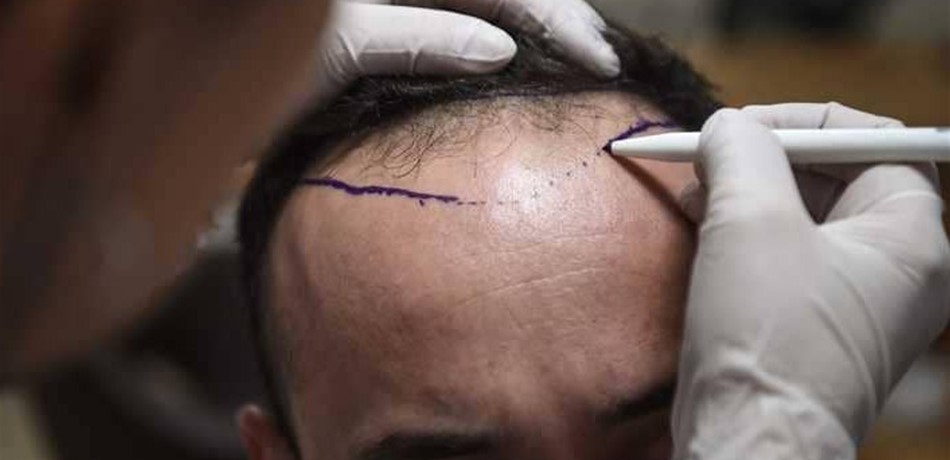 للرجال الصلع.. نمو الشعر بات ممكنا في 6 أيام