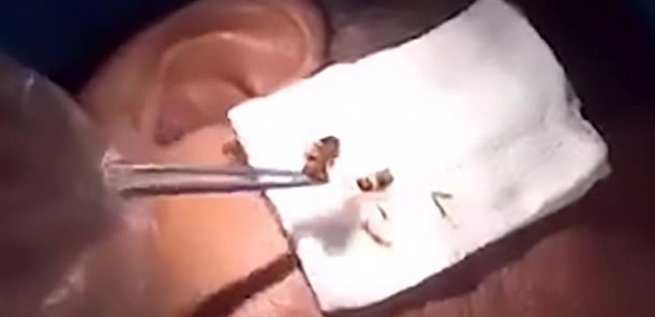 بالصور.. صرصار استقر في داخل أذن رجل 6 ساعات!