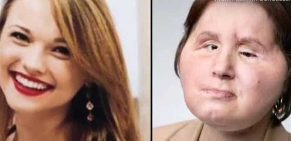 حصلت على "وجه جديد" بعد أن شوّهت وجهها في محاولة انتحار فاشلة