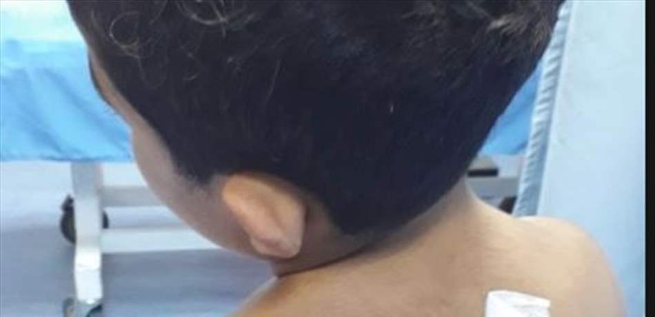 نجاة طفل بأعجوبة من رصاصة طائشة.. اخترقت جسده لتخرج من أسفل كتفه