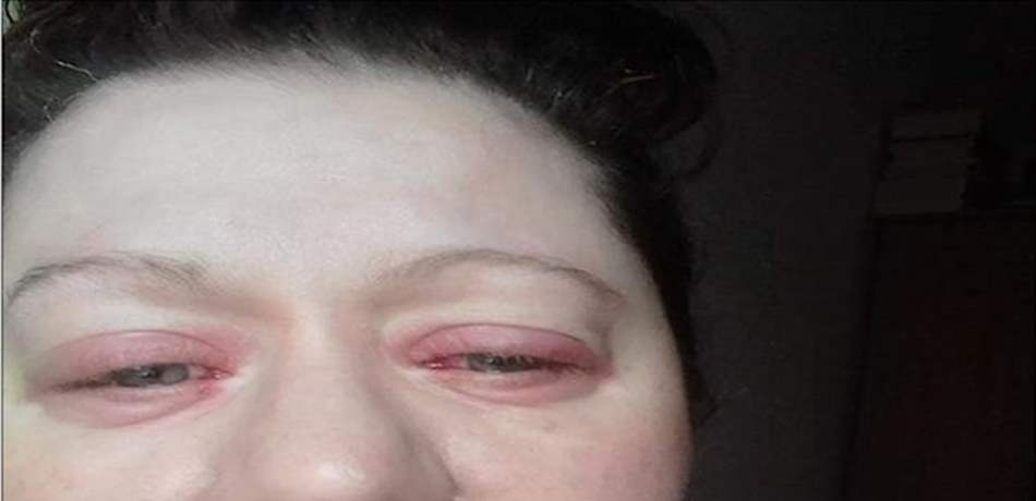 حالة صحية نادرة.. تذرف الدماء من عينيها وجلدها يتساقط!