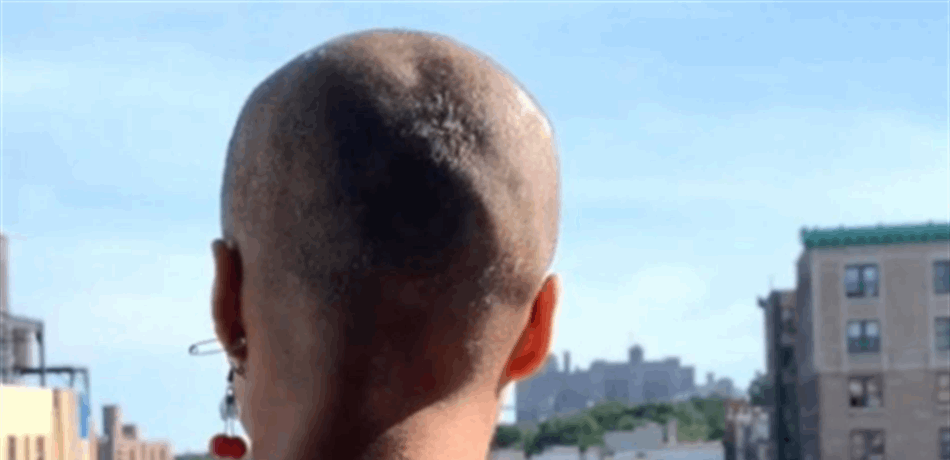 أصبحت صلعاء بسبب صبغة الشعر.. انتبهي لما حدث معها